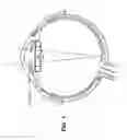 Fig. 02 - Intraocular lens system with folding features