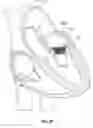 Fig. 72 - Replacement mitral valves