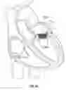 Fig. 72 - Replacement mitral valves