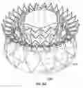 Fig. 74 - Replacement mitral valves