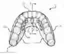 Fig. 01 - Method and oral appliance for improving air intake and reducing bruxism