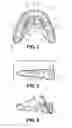 Fig. 02 - Method and oral appliance for improving air intake and reducing bruxism
