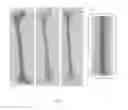 Fig. 02 - Hybrid implant system and manufacturing method therefor