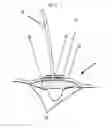 Fig. 03 - RELEASABLY SEALABLE WOUND DRESSING FOR NPWT