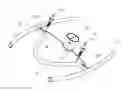 Fig. 01 - Contactless actuation for valve implant