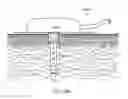 Fig. 34 - CONTINUOUS SUBCUTANEOUS INSULIN INFUSION CATHETER