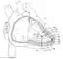 Fig. 01 - Delivery devices and methods for leadless cardiac devices