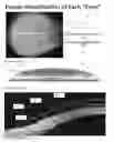 Fig. 02 - Contact lens using indicia to aid fitting