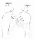Fig. 01 - Recharge of implanted medical devices