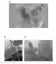 Fig. 01 - Method for producing haploid, dihaploid and doubled haploid plants by isolated microspore culture