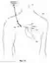 Fig. 02 - Medical device including feedthrough assembly