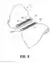 Fig. 06 - Buttress attachment features for surgical stapling apparatus