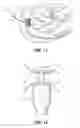 Fig. 09 - Buttress attachment features for surgical stapling apparatus