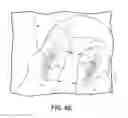 Fig. 09 - Magnetic tissue compression device with backup mechanical latch