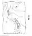 Fig. 07 - Battery powered electromagnetic tissue compression device
