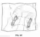 Fig. 10 - Battery powered electromagnetic tissue compression device