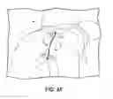 Fig. 11 - Battery powered electromagnetic tissue compression device