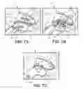 Fig. 12 - Battery powered electromagnetic tissue compression device