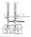 Fig. 01 - Spinal trauma correction and fixation