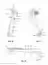 Fig. 11 - Spinal trauma correction and fixation