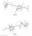 Fig. 12 - Spinal trauma correction and fixation