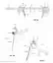 Fig. 13 - Spinal trauma correction and fixation