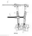 Fig. 30 - Spinal trauma correction and fixation