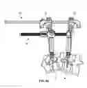 Fig. 31 - Spinal trauma correction and fixation