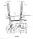 Fig. 36 - Spinal trauma correction and fixation