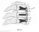 Fig. 06 - Apparatus for fixing cervical spine
