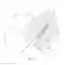 Fig. 13 - Helicoil Interference Fixation System For Attaching a Graft Ligament to a Bone