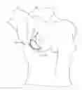 Fig. 01 - Surgical Template and Delivery Device