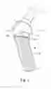 Fig. 02 - JOINT IMPLANT COMPONENT HAVING A FIXATION STRUCTURE FOR SOFT TISSUE