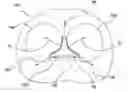 Fig. 01 - Retracting or/and supporting periurethral tissue
