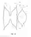 Fig. 03 - Short stent