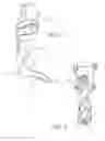 Fig. 03 - Dynamic exoskeletal orthosis
