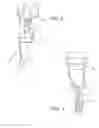 Fig. 06 - Dynamic exoskeletal orthosis