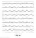 Fig. 07 - BOND PATTERNS AS A MEANS TO DRIVE HIGH RELIEF AND TOPOGRAPHY IN ELASTIC LAMINATES