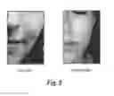 Fig. 06 - SEMI-SOLID TOPICAL COMPOSITION CONTAINING PIRFENIDONE AND MODIFIED DIALLYL DISULFIDE OXIDE (M-DDO) FOR ELIMINATING OR PREVENTING ACNE