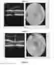 Fig. 04 - Methods and compositions for treating genetically linked diseases of the eye