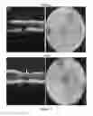 Fig. 15 - Methods and compositions for treating genetically linked diseases of the eye
