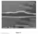 Fig. 04 - Medical devices coated with shape memory polymer foams