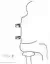 Fig. 06 - Cupping syringe