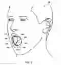 Fig. 03 - PROTECTIVE AND HEALING INNER CHEEK PADS