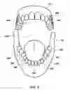 Fig. 10 - PROTECTIVE AND HEALING INNER CHEEK PADS