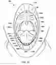 Fig. 11 - PROTECTIVE AND HEALING INNER CHEEK PADS