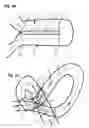 Fig. 04 - Process of treating a workpiece using a liquid jet guided laser beam