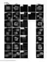 Fig. 85 - Methods and compositions for producing pancreatic beta cells