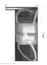 Fig. 06 - Inductor system having shared material for flux cancellation