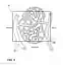 Fig. 05 - ASSESSMENT OF MICROVASCULAR DYSFUNCTION WITH SPECTRAL IMAGING